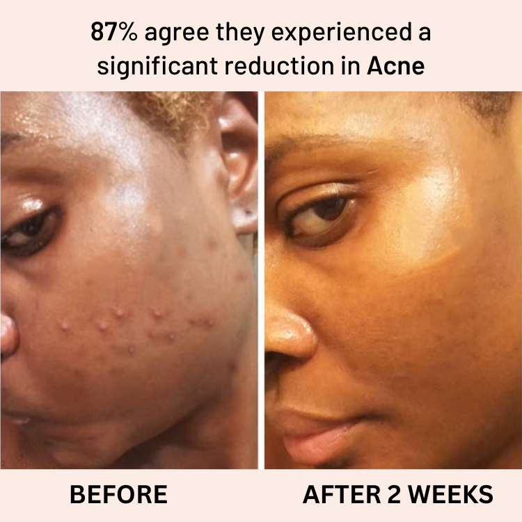 Anti-Acne & Dark Spots African Soap