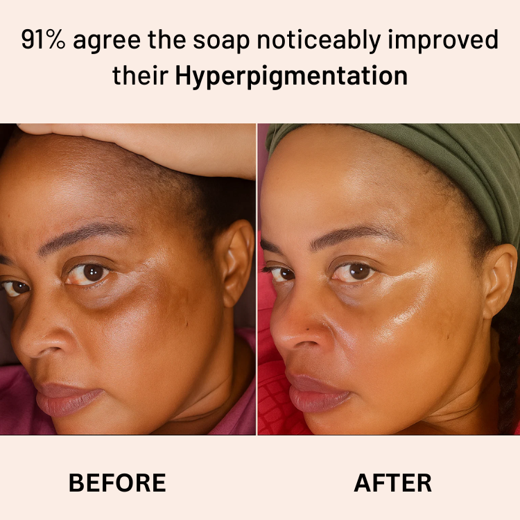 Anti-Acne & Dark Spots African Soap