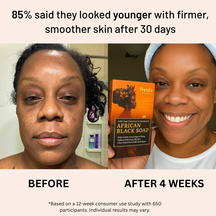 Anti-Acne & Dark Spots African Soap