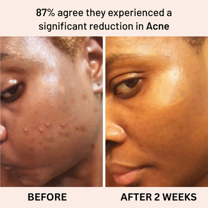 Anti-Acne & Dark Spots African Soap