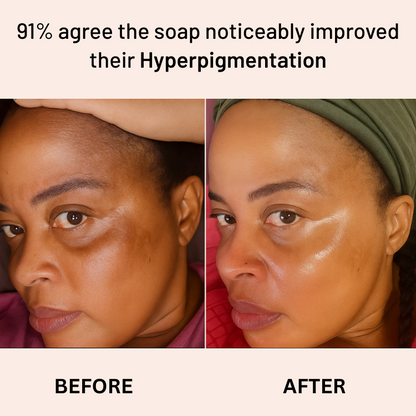 Anti-Acne & Dark Spots African Soap