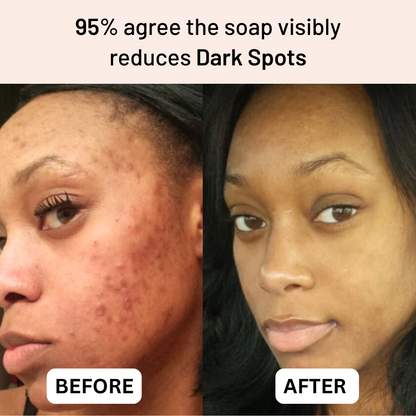 Anti-Acne & Dark Spots African Soap