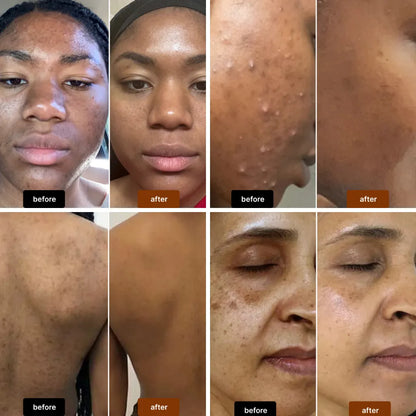 Anti-Acne & Dark Spots African Soap